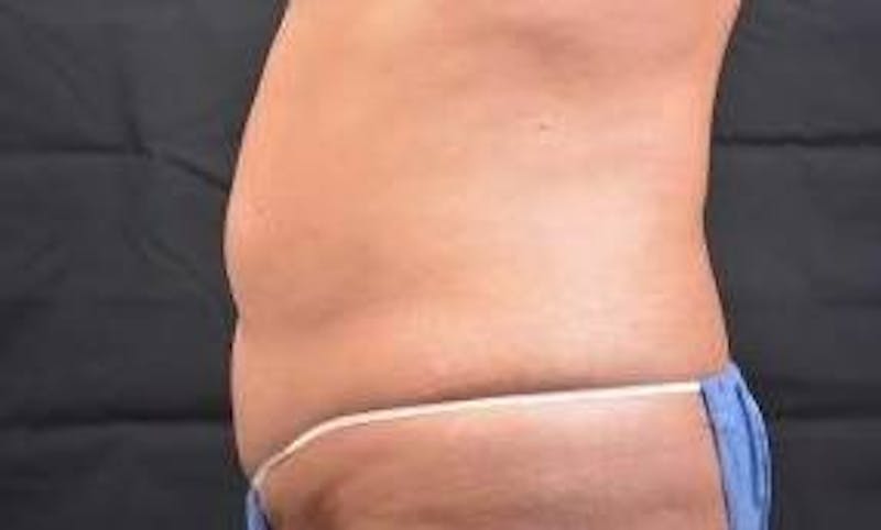 Abdominoplasty Before & After Gallery - Patient 410231 - Image 3