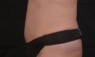 Abdominoplasty Before & After Gallery - Patient 410231 - Image 4