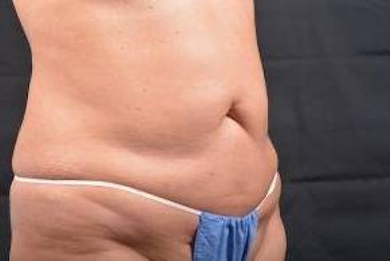 Abdominoplasty Before & After Gallery - Patient 410231 - Image 9