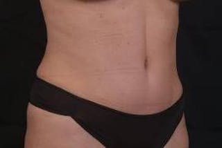 Abdominoplasty Before & After Gallery - Patient 410231 - Image 10