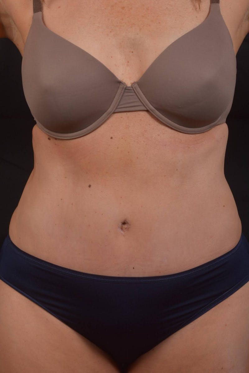 Abdominoplasty Before & After Gallery - Patient 315949 - Image 2
