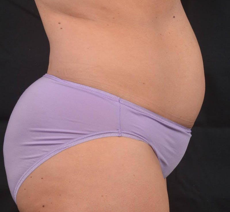 Abdominoplasty Before & After Gallery - Patient 315949 - Image 5