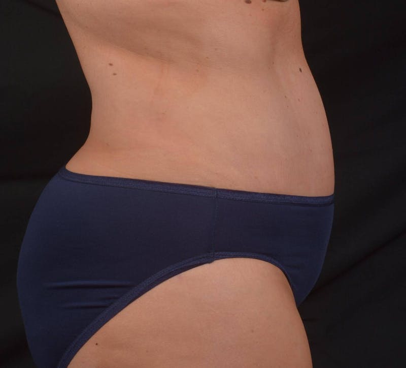 Abdominoplasty Before & After Gallery - Patient 315949 - Image 6