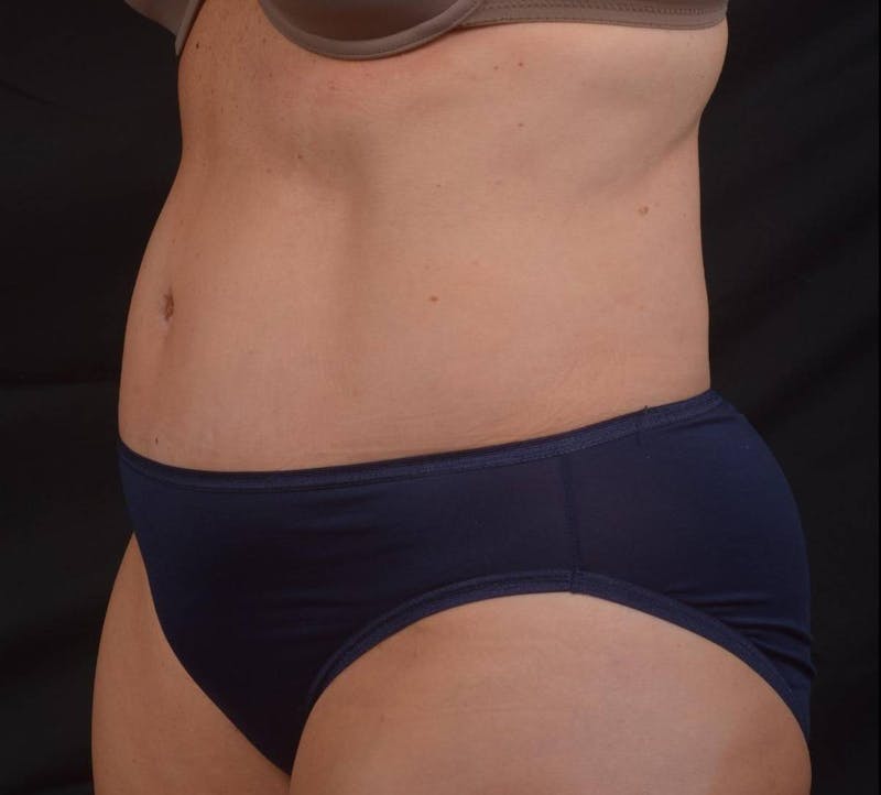 Abdominoplasty Before & After Gallery - Patient 315949 - Image 8