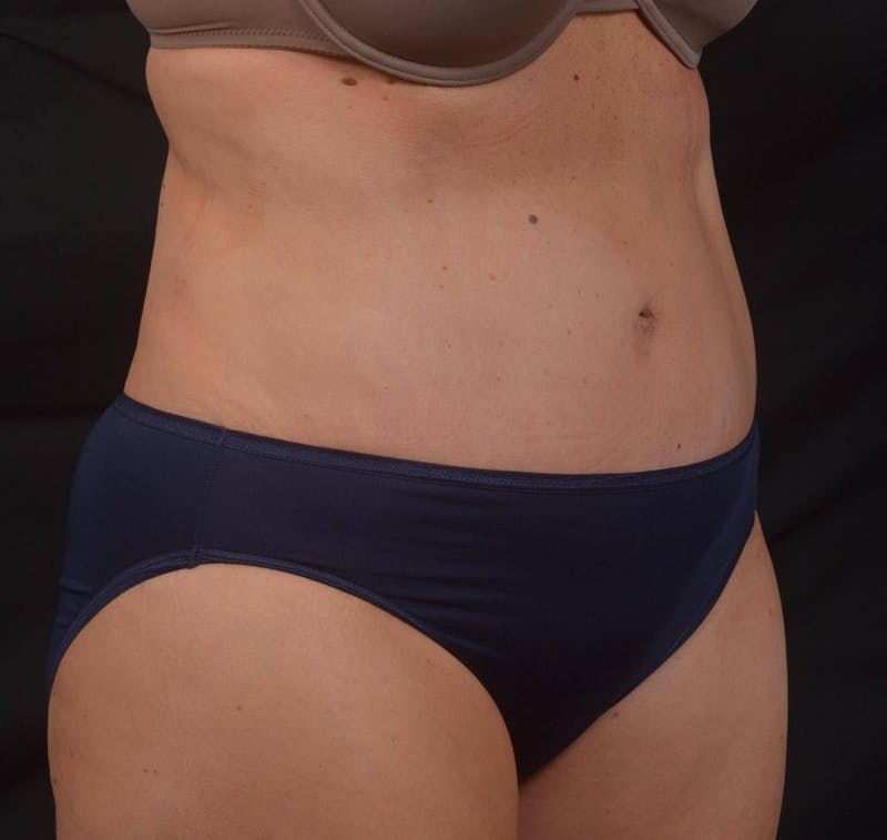 Abdominoplasty Before & After Gallery - Patient 315949 - Image 10