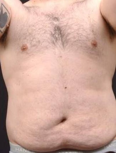 Abdominoplasty Before & After Gallery - Patient 384285 - Image 1