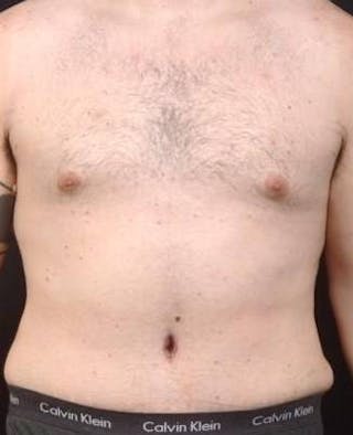 Abdominoplasty Before & After Gallery - Patient 384285 - Image 2