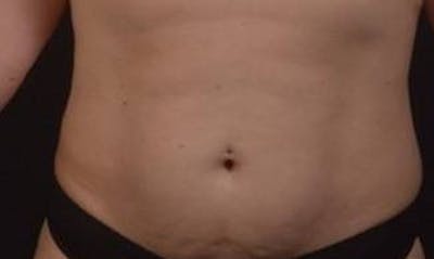 Abdominoplasty Before & After Gallery - Patient 239922 - Image 1