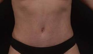 Abdominoplasty Before & After Gallery - Patient 239922 - Image 2