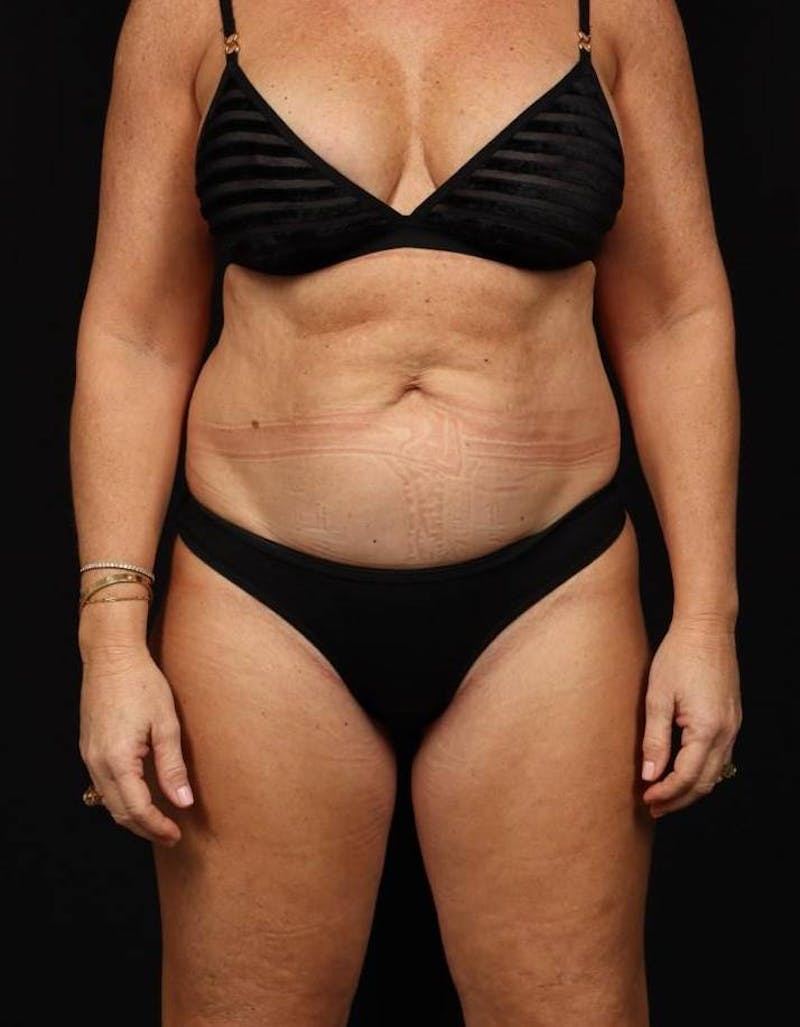 360 Liposuction Before & After Gallery - Patient 513562 - Image 1