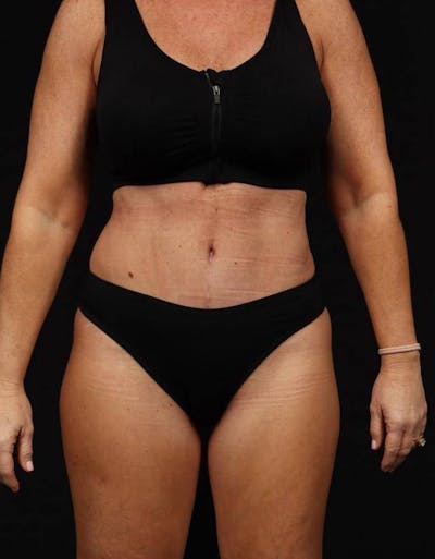 Abdominoplasty Before & After Gallery - Patient 286922 - Image 2