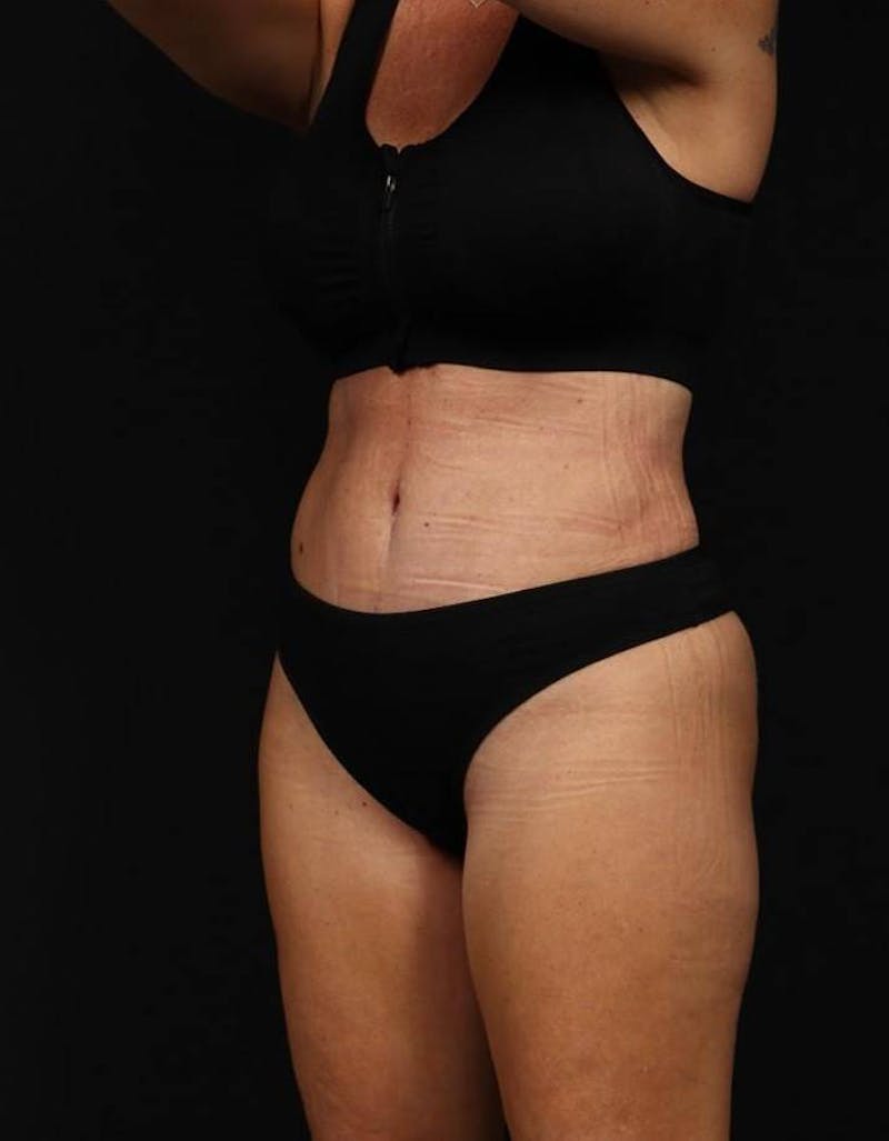 360 Liposuction Before & After Gallery - Patient 513562 - Image 4