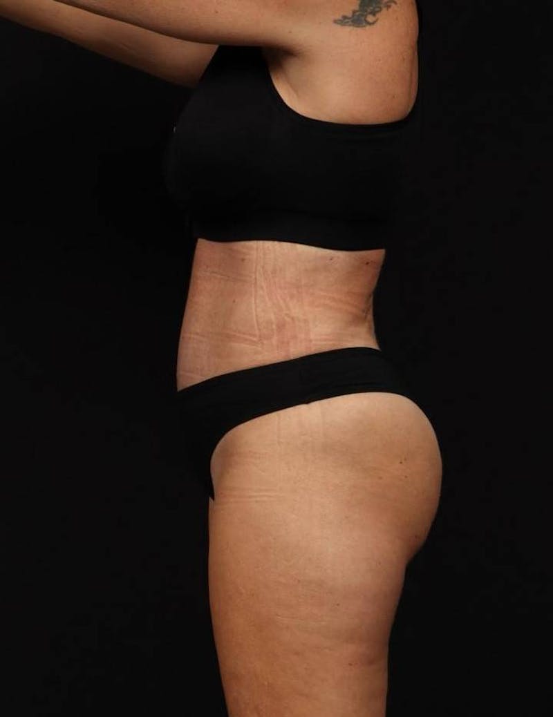 Abdominoplasty Before & After Gallery - Patient 286922 - Image 6