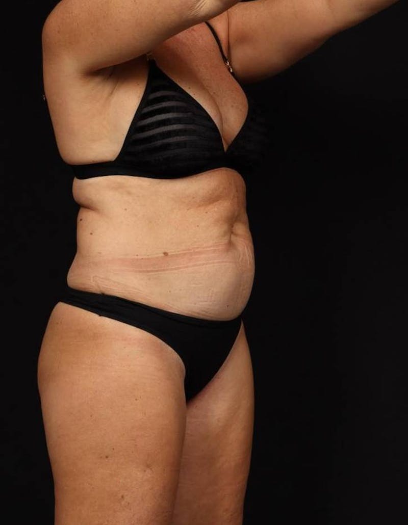 Abdominoplasty Before & After Gallery - Patient 286922 - Image 7