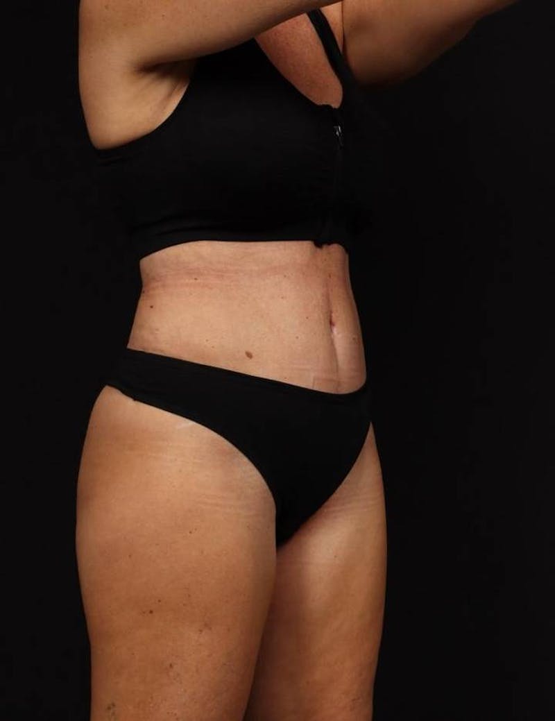 Abdominoplasty Before & After Gallery - Patient 286922 - Image 8