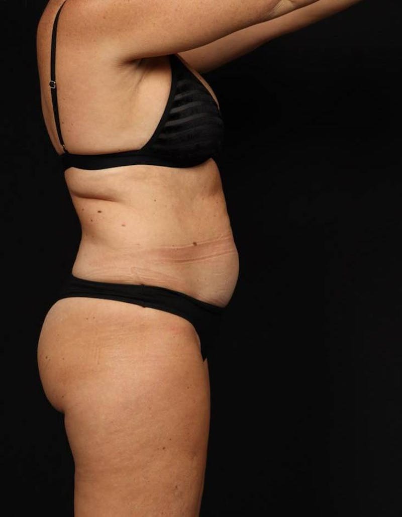 Abdominoplasty Before & After Gallery - Patient 286922 - Image 9