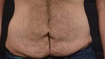 Abdominoplasty Before & After Gallery - Patient 367208 - Image 1