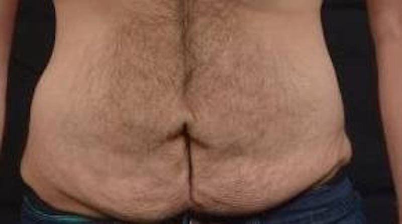 Abdominoplasty Before & After Gallery - Patient 367208 - Image 1