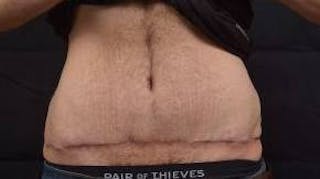 Abdominoplasty Before & After Gallery - Patient 367208 - Image 2