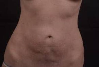 Abdominoplasty Before & After Gallery - Patient 127737 - Image 1
