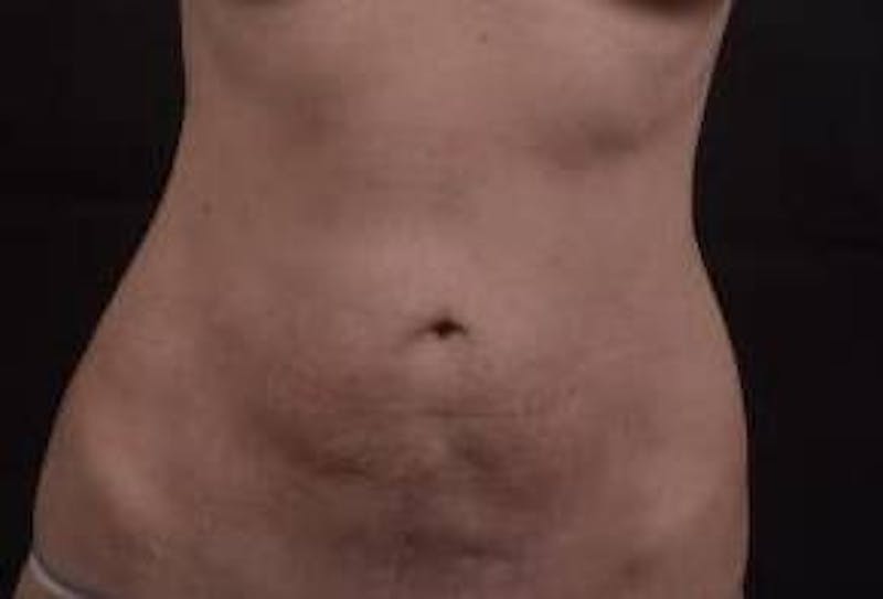 Abdominoplasty Before & After Gallery - Patient 127737 - Image 1
