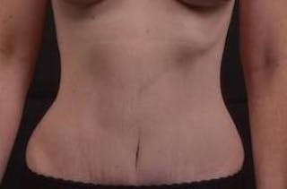 Abdominoplasty Before & After Gallery - Patient 127737 - Image 2