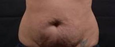 Abdominoplasty Before & After Gallery - Patient 135080 - Image 1