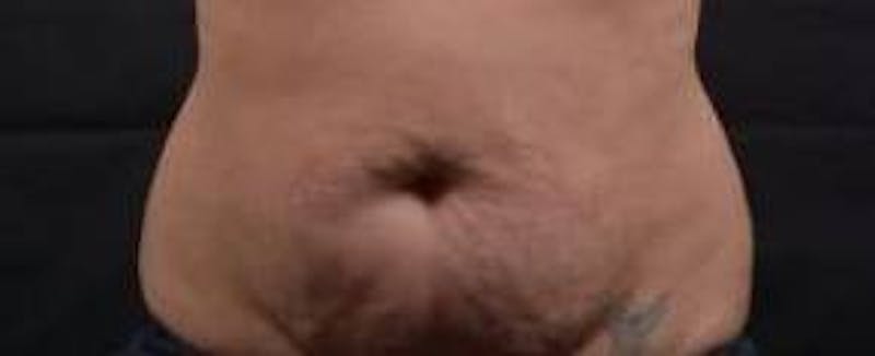 Abdominoplasty Before & After Gallery - Patient 135080 - Image 1
