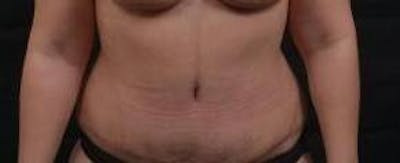 Abdominoplasty Before & After Gallery - Patient 135080 - Image 2