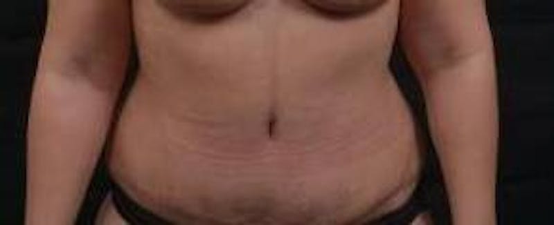 Abdominoplasty Before & After Gallery - Patient 135080 - Image 2