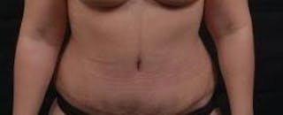 Abdominoplasty Before & After Gallery - Patient 135080 - Image 2