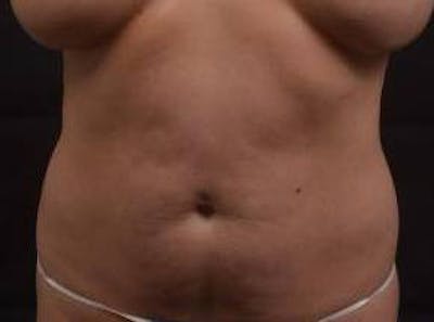 Abdominoplasty Before & After Gallery - Patient 342786 - Image 1