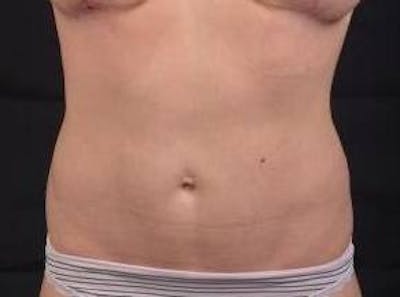 Abdominoplasty Before & After Gallery - Patient 342786 - Image 2