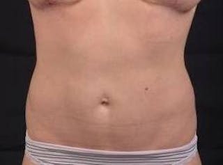 Abdominoplasty Before & After Gallery - Patient 342786 - Image 2