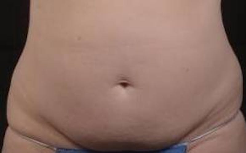 Abdominoplasty Before & After Gallery - Patient 201851 - Image 1