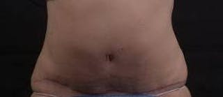 Abdominoplasty Before & After Gallery - Patient 201851 - Image 2