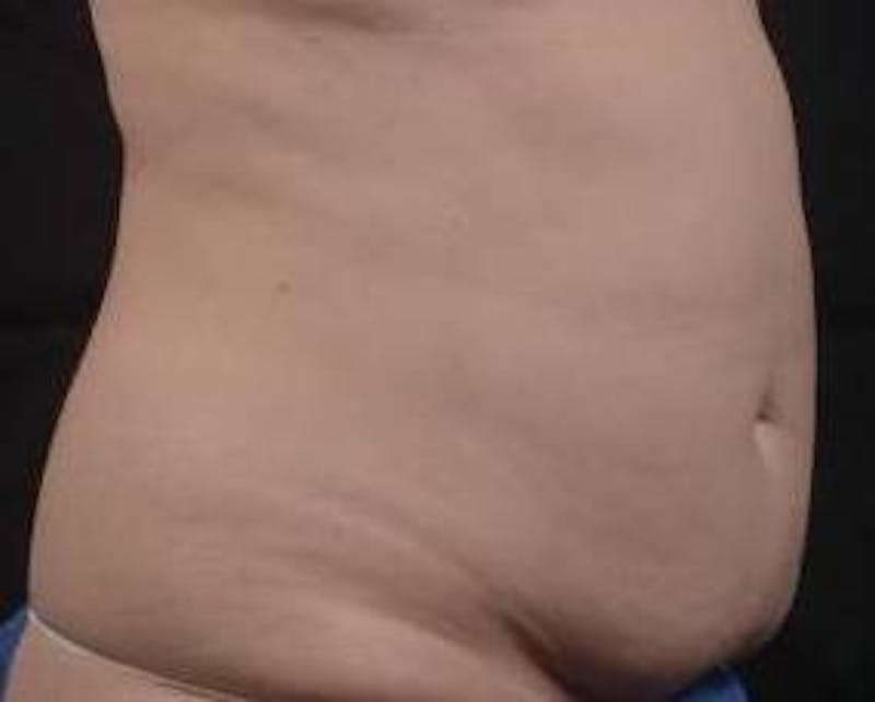 Abdominoplasty Before & After Gallery - Patient 201851 - Image 9