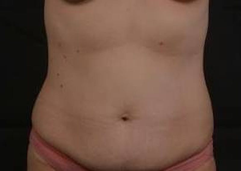 Abdominoplasty Before & After Gallery - Patient 799904 - Image 1