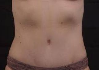 Abdominoplasty Before & After Gallery - Patient 799904 - Image 2