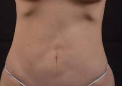 Abdominoplasty Before & After Gallery - Patient 250524 - Image 1