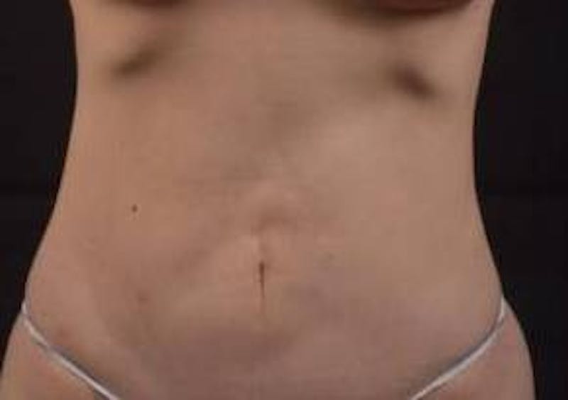 Abdominoplasty Before & After Gallery - Patient 250524 - Image 1