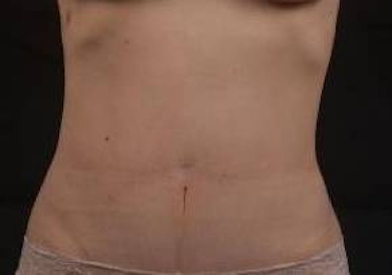 Abdominoplasty Before & After Gallery - Patient 250524 - Image 2