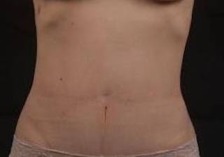 Abdominoplasty Before & After Gallery - Patient 250524 - Image 2