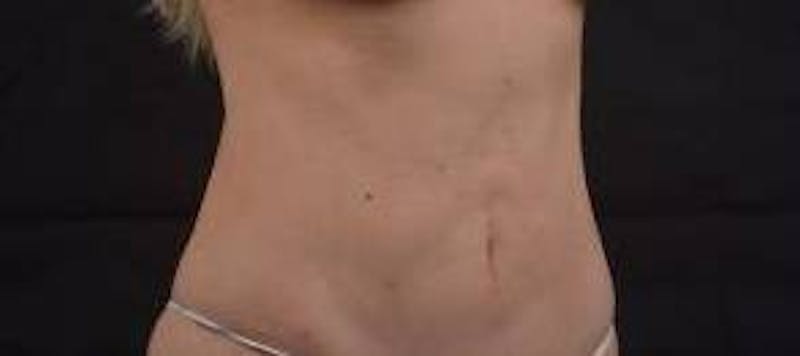 Abdominoplasty Before & After Gallery - Patient 250524 - Image 9