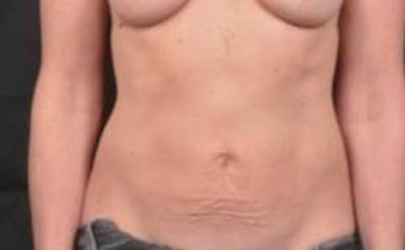 Abdominoplasty Before & After Gallery - Patient 298656 - Image 1