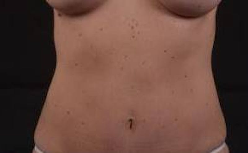 Abdominoplasty Before & After Gallery - Patient 298656 - Image 2