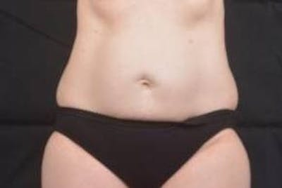 Abdominoplasty Before & After Gallery - Patient 297964 - Image 1