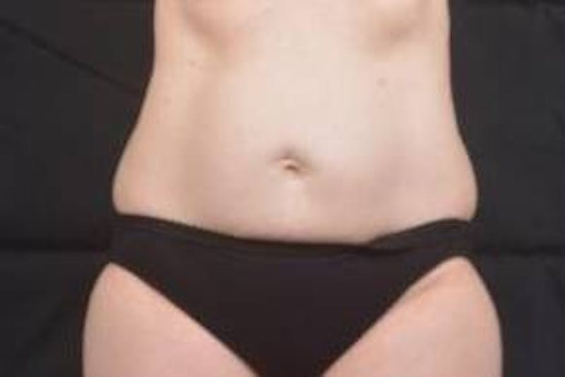 Abdominoplasty Before & After Gallery - Patient 297964 - Image 1