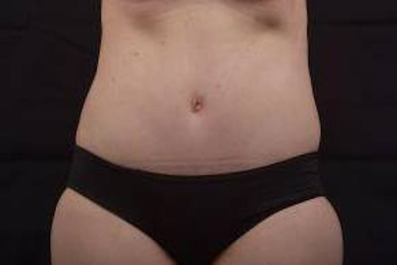 Abdominoplasty Before & After Gallery - Patient 297964 - Image 2