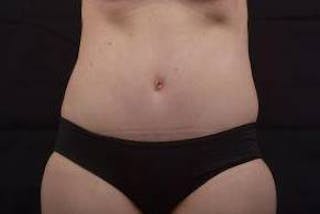 Abdominoplasty Before & After Gallery - Patient 297964 - Image 2